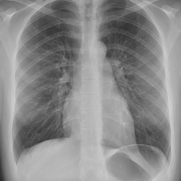 Fibrose Cística: Orientações fisioterapêuticas