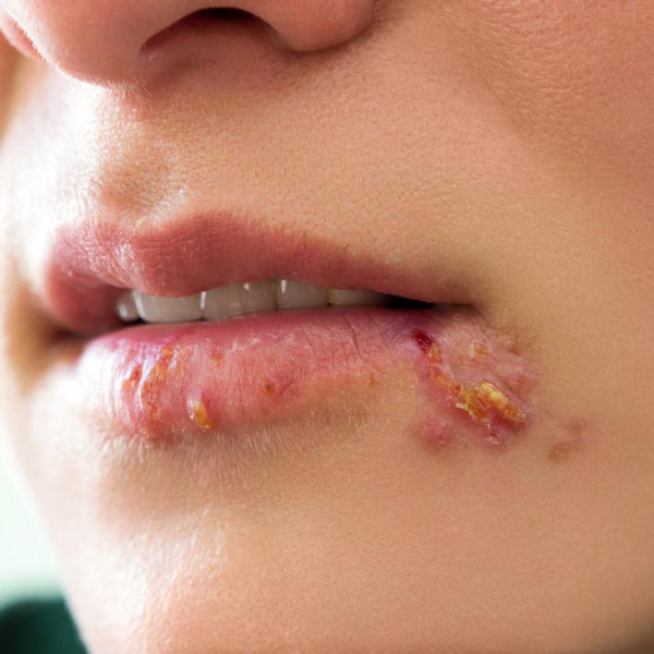 Leia mais sobre o artigo 2º Curso de Atualização – Manifestações bucais de Infecções Sexualmente Transmissíveis