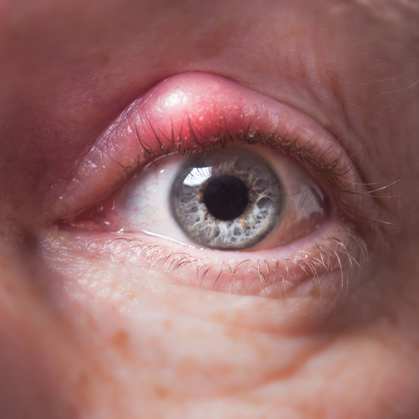 Problemas Oculares Frequentes na APS