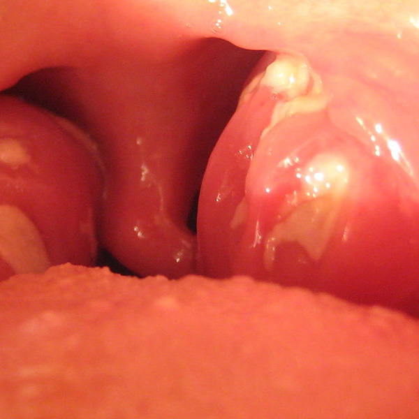 Mononucleose infecciosa e as síndromes mono-like – o que eu devo investigar na atenção primária?
