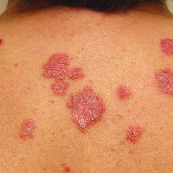 Lupus na APS: Quando suspeitar e como iniciar a investigação