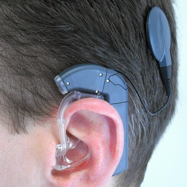 Rede de Atenção a Deficiência Auditiva- Implante Coclear