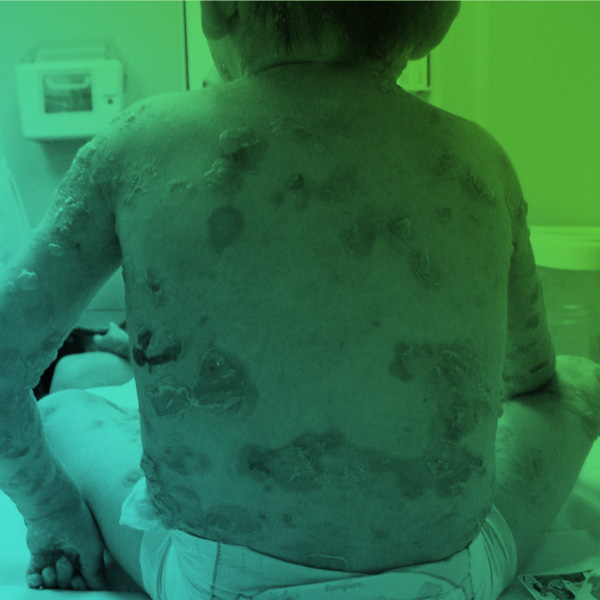 A atuação do Cirurgião-dentista no atendimento a pacientes com Epidermólise Bolhosa