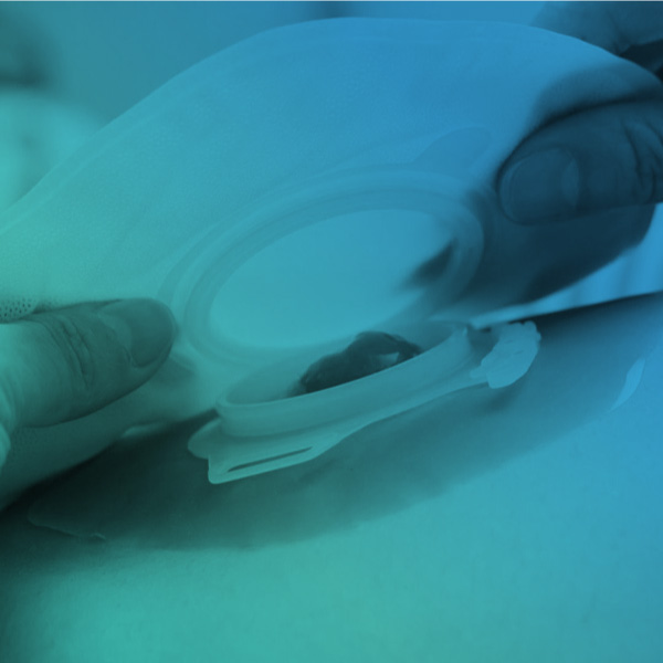 Cadastro para Paciente Estomizado – Capacitação para a AB