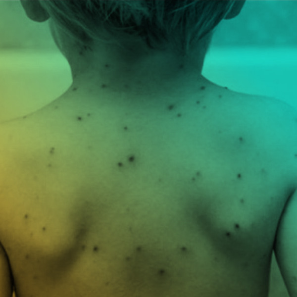 Sarampo – suspeita, manejo e prevenção