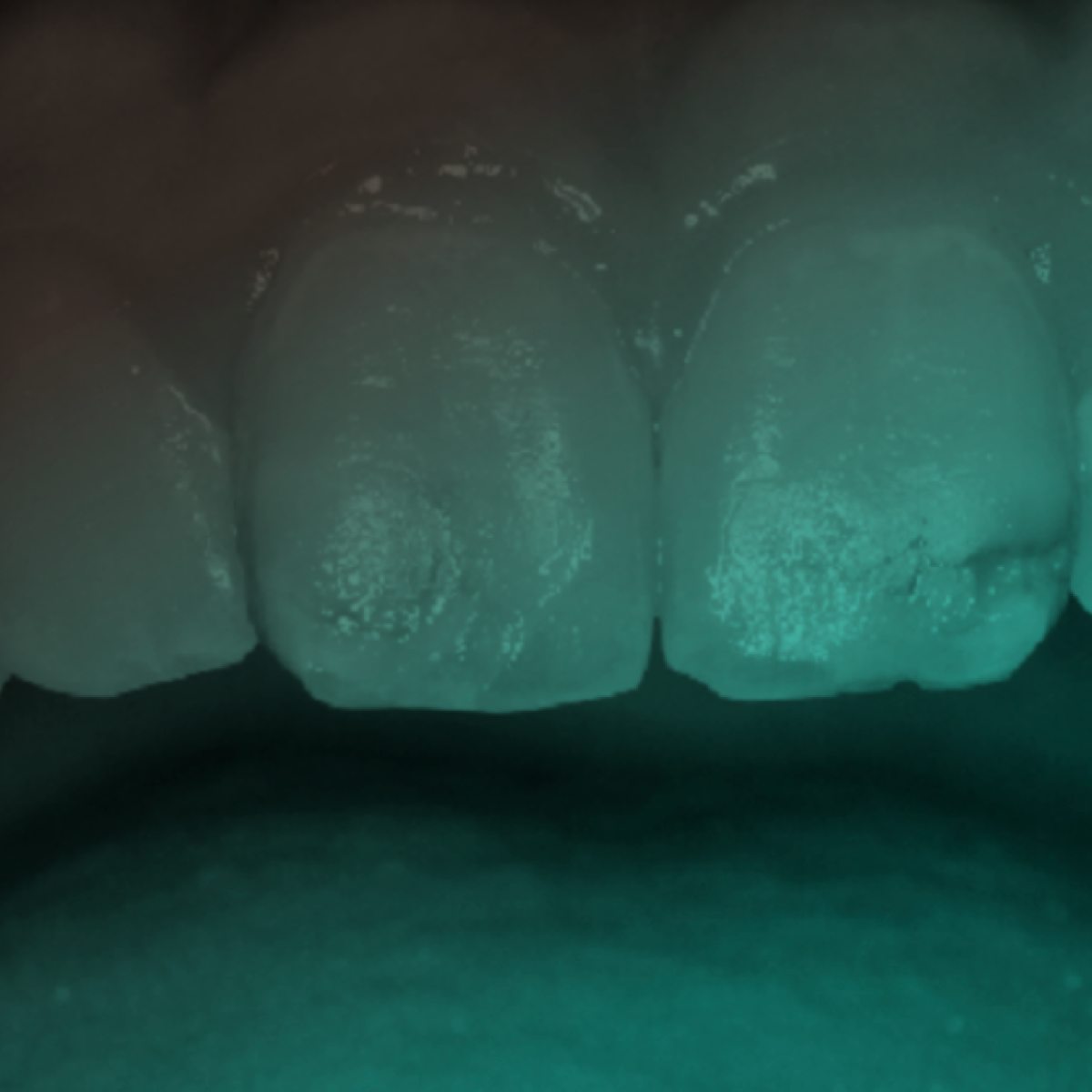 ADIADA: Novos conceitos da cárie dentária e suas implicações