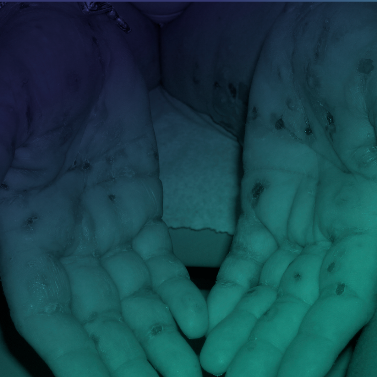 Aspectos nutricionais na Epidermólise Bolhosa