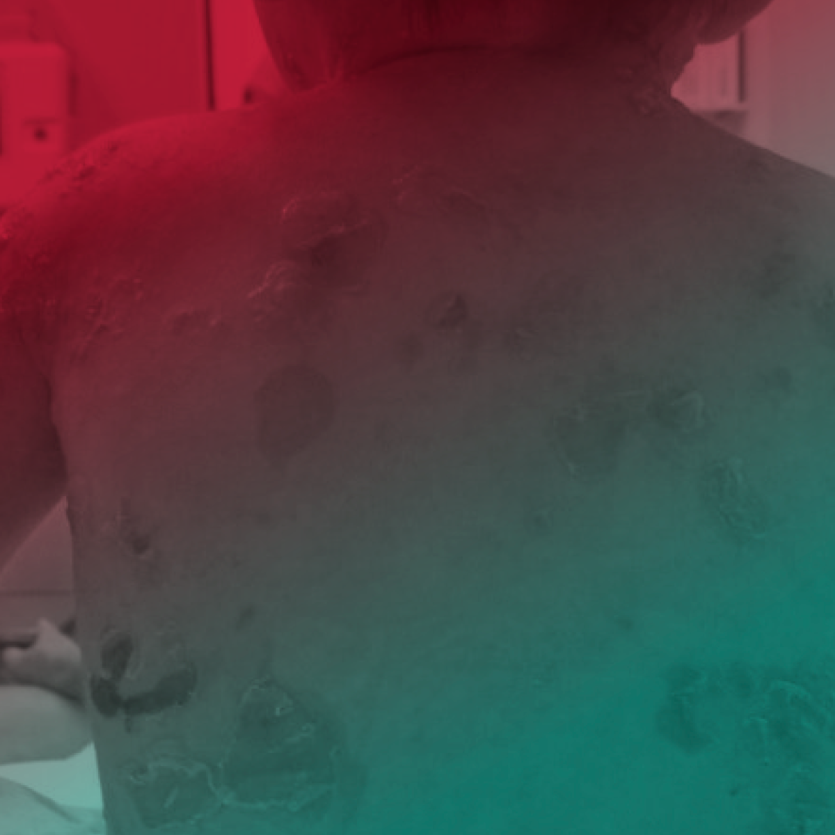 Epidermólise Bolhosa - Atualizações  e Pesquisas