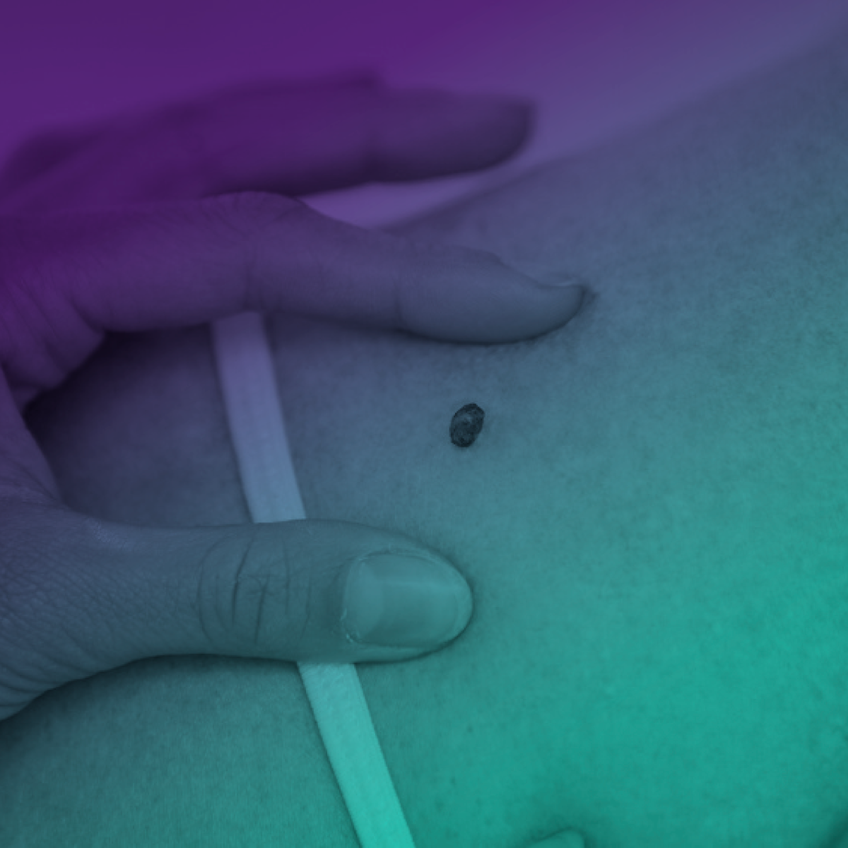 Câncer de Pele: manejo na APS